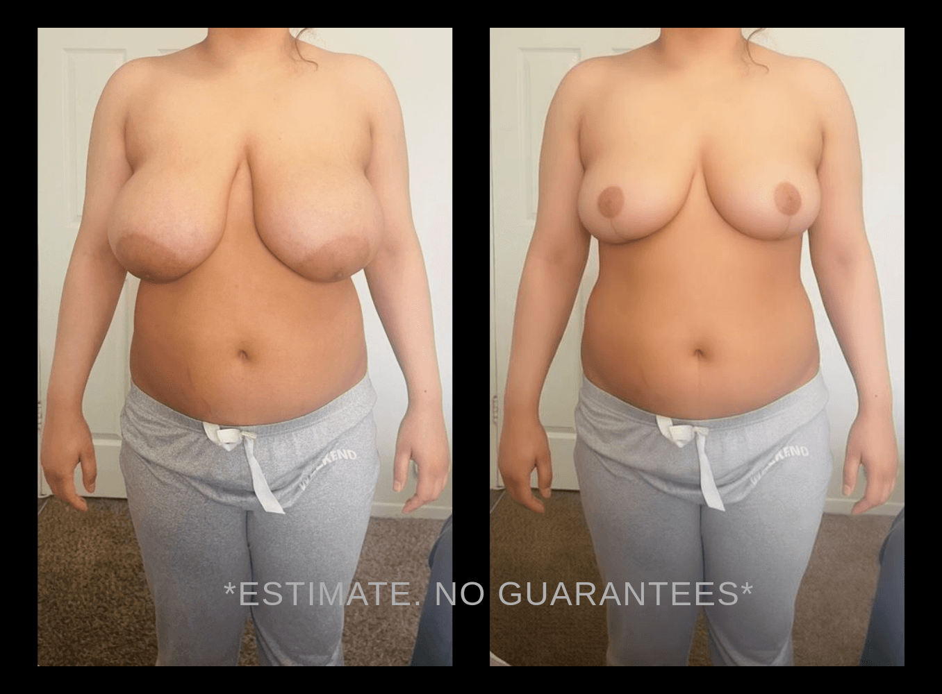 AI plastic surgery simulation showing breast reduction before and after