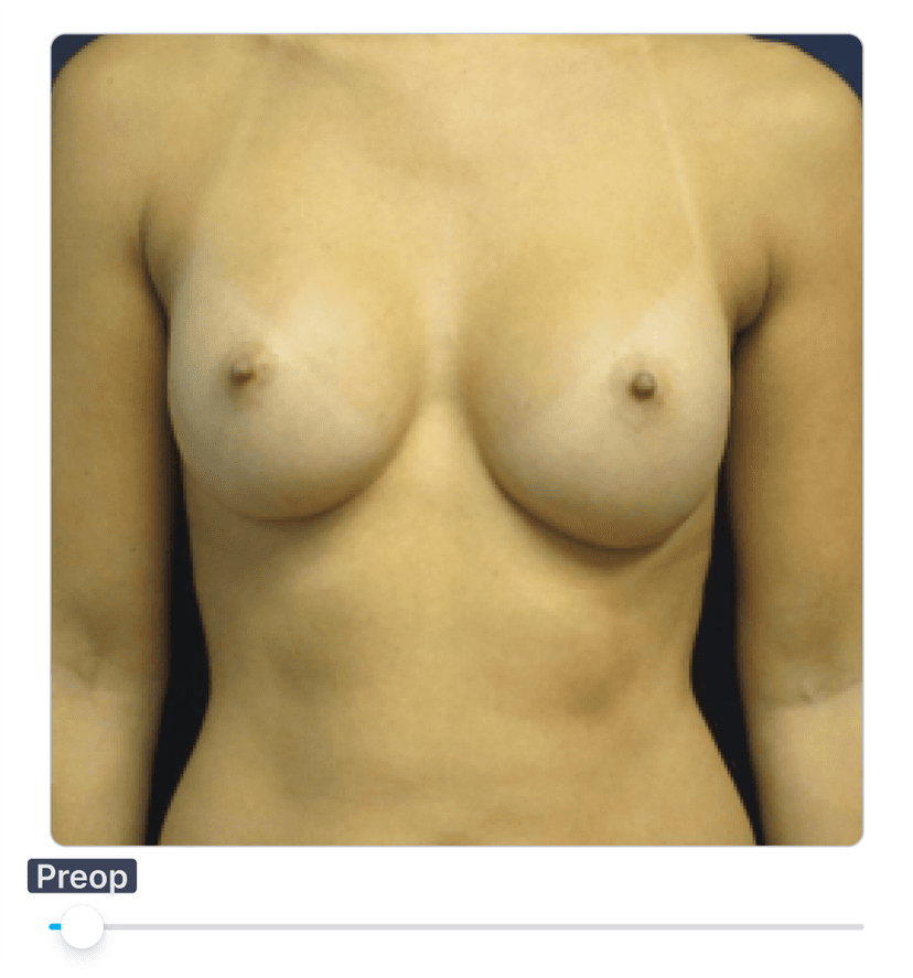 AI Plastic Surgery Simulation: How It Works and Why Surgeons Use It