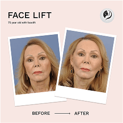 Before and after result 3