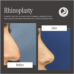 Before and after result 4