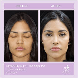 Before and after result 5