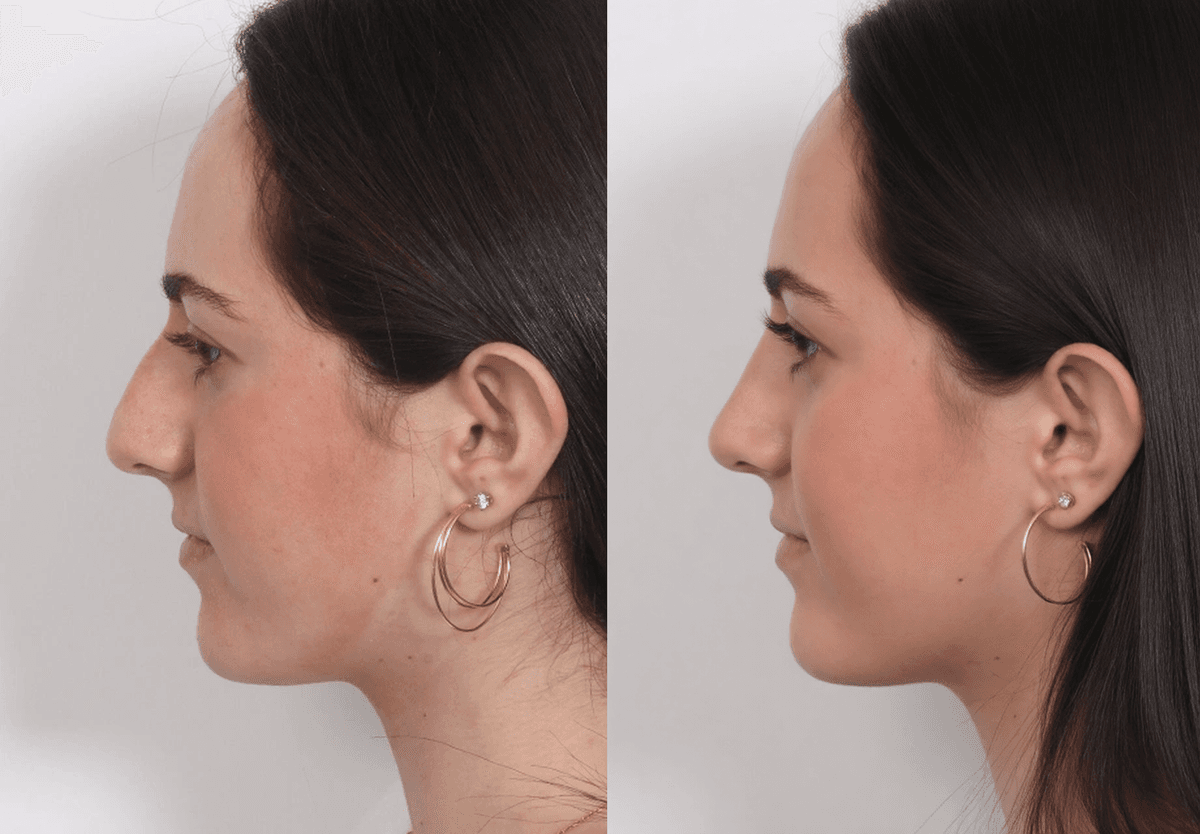 Rhinoplasty simulation example 1