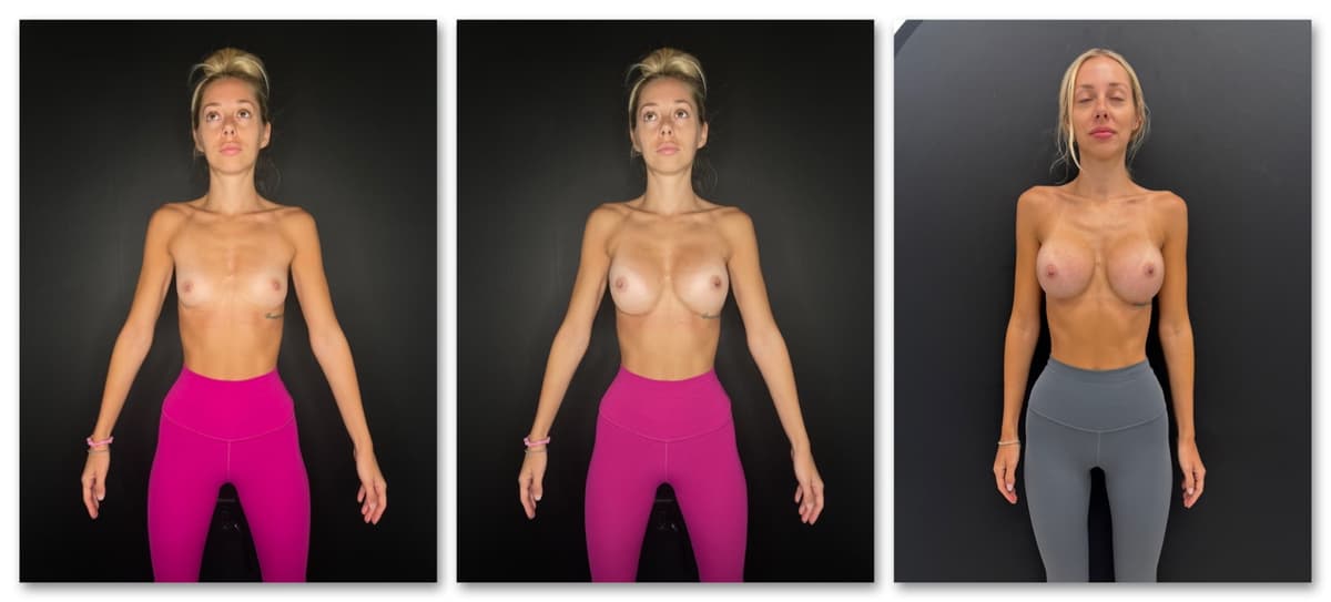 Breast Augmentation simulation example 1
