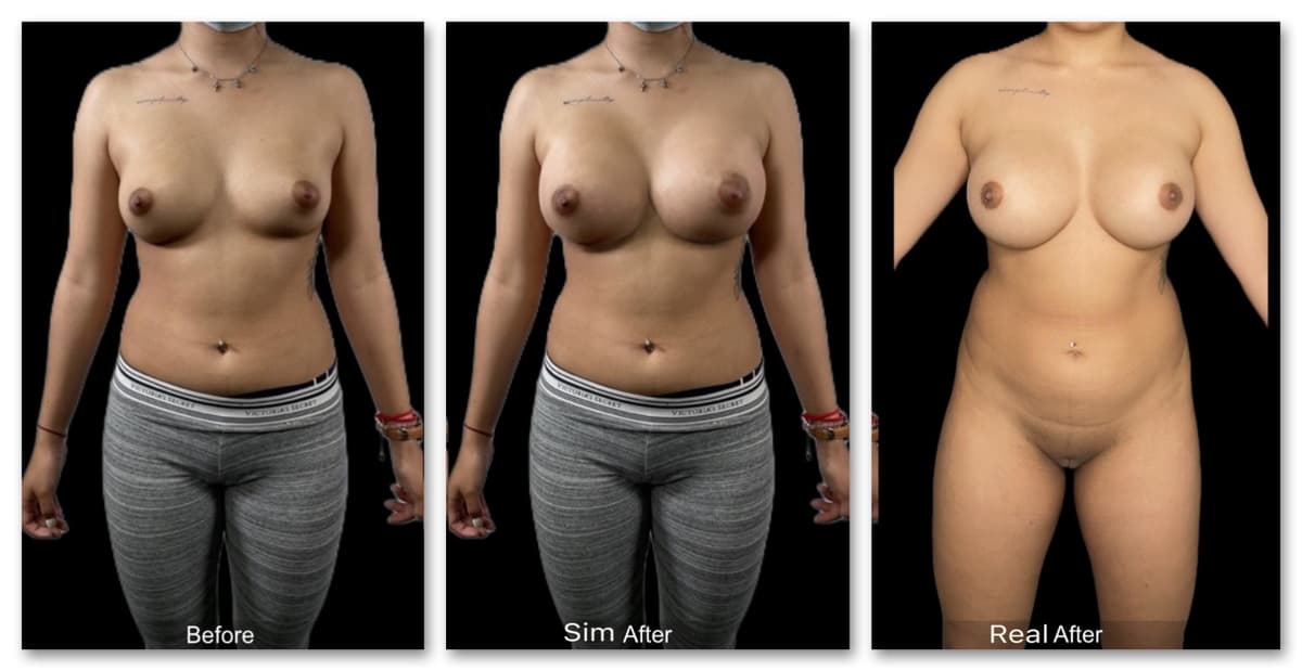 Breast Augmentation simulation example 2