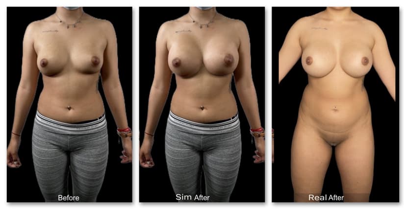 AI-generated breast augmentation simulation