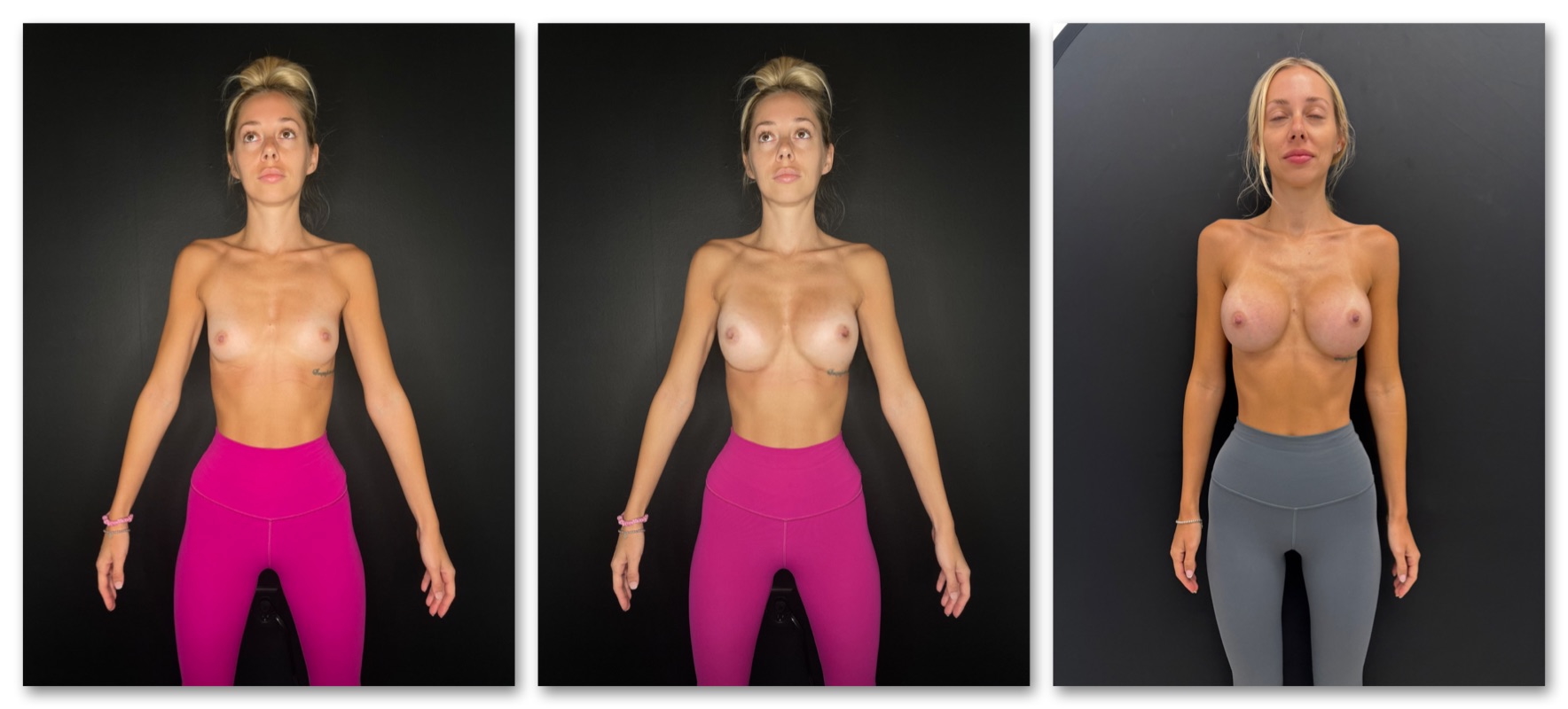 Breast Augmentation simulation example 1